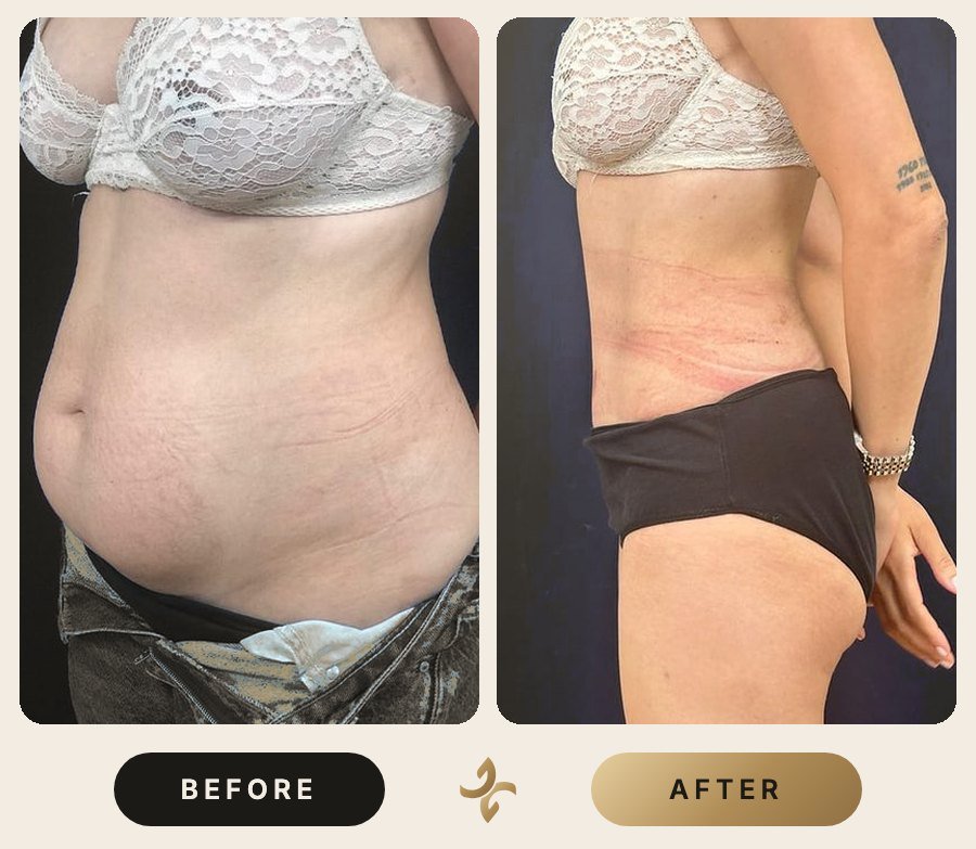 Karın Germe (Abdominoplasti) – önce ve sonra, hasta izniyle