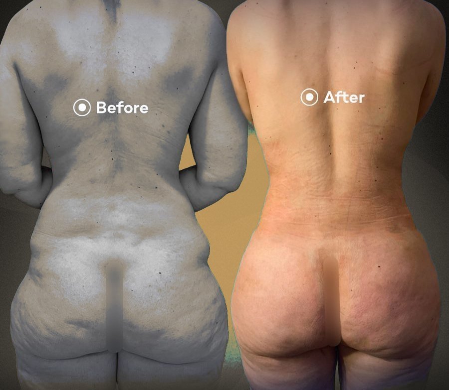 Liposuction & Vücut Şekillendirme – önce ve sonra, hasta izniyle