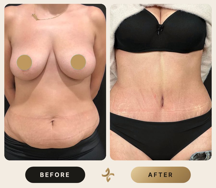 Karın Germe (Abdominoplasti) – önce ve sonra, hasta izniyle
