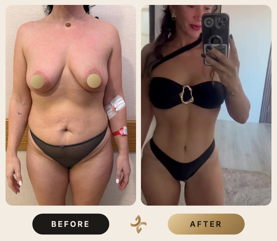 Vücut Şekillendirme ve Mommy Makeover – önce ve sonra, hasta izniyle