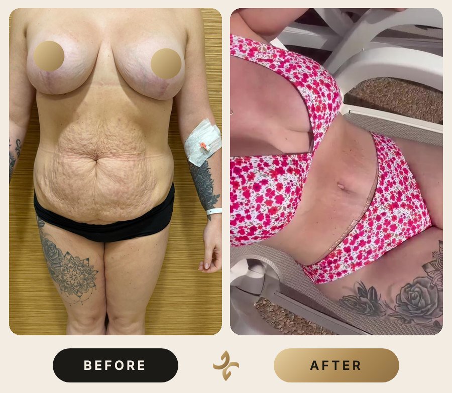 Vücut Şekillendirme ve Mommy Makeover – önce ve sonra, hasta izniyle