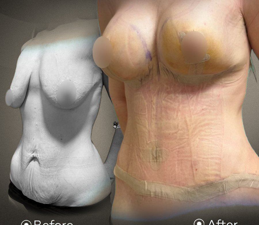 Mommy Makeover – önce ve sonra, hasta izniyle