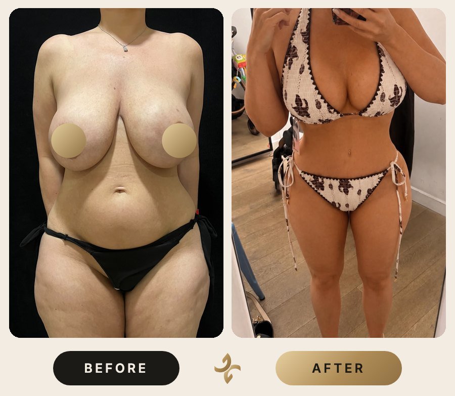 Vücut Şekillendirme ve Mommy Makeover – önce ve sonra, hasta izniyle