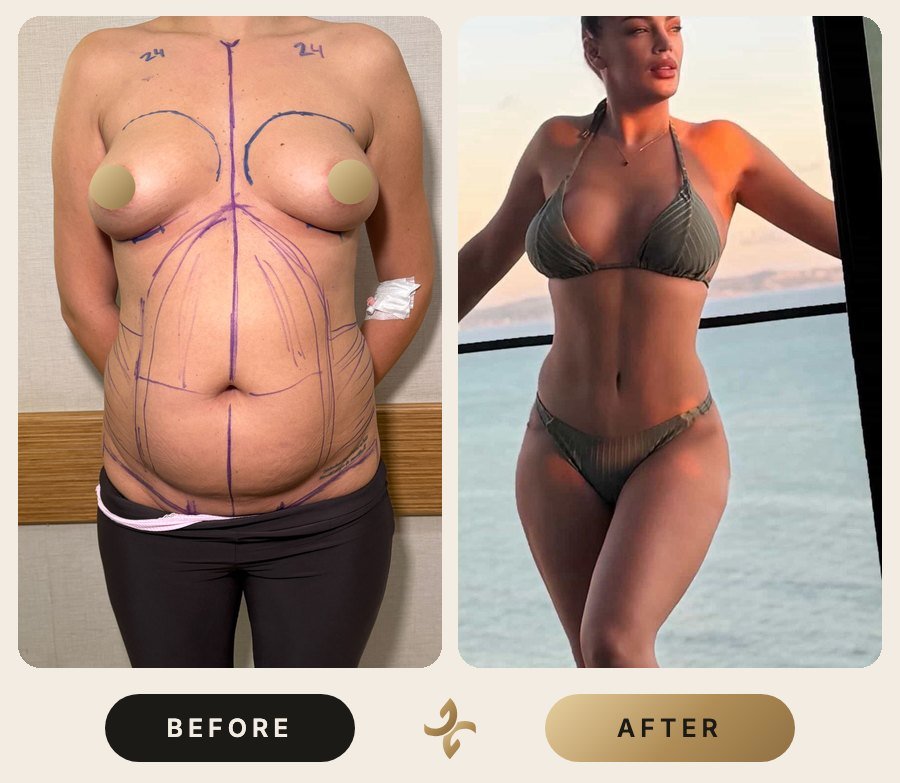 Vücut Şekillendirme ve Mommy Makeover – önce ve sonra, hasta izniyle