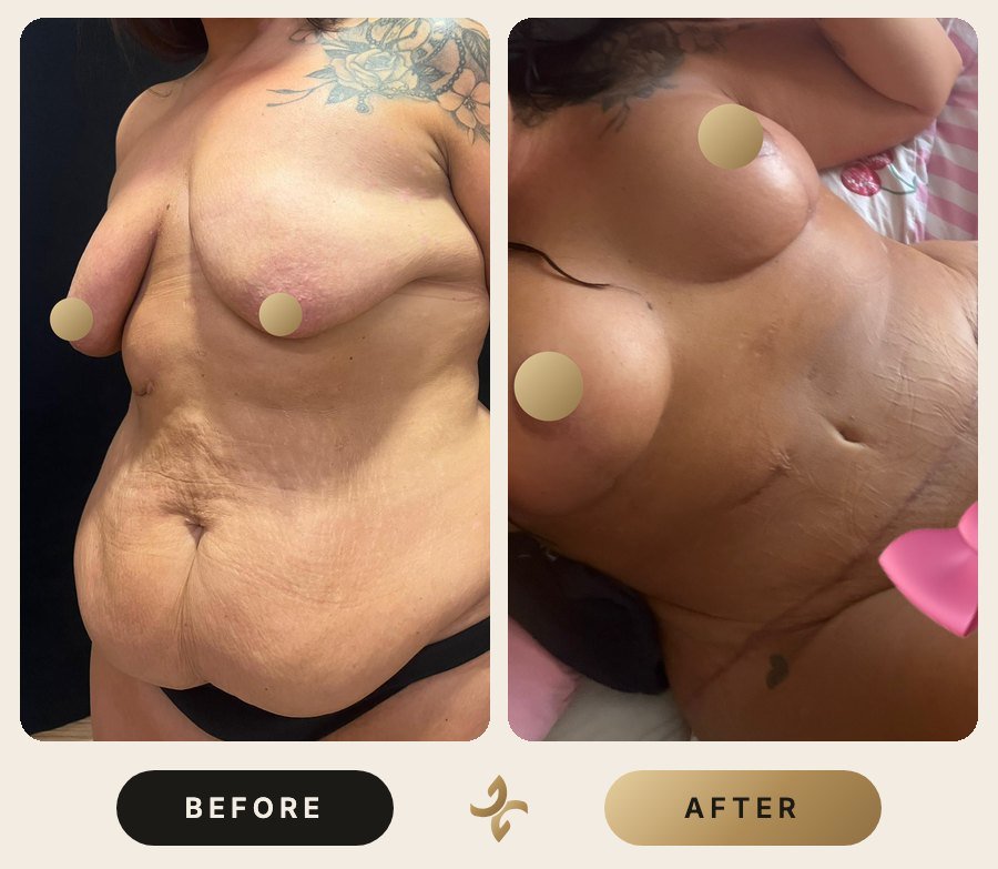 Vücut Şekillendirme ve Mommy Makeover – önce ve sonra, hasta izniyle