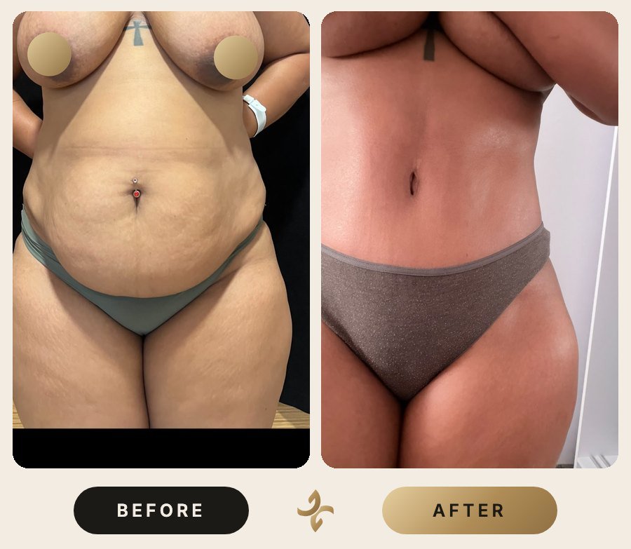 Vücut Şekillendirme ve Mommy Makeover – önce ve sonra, hasta izniyle
