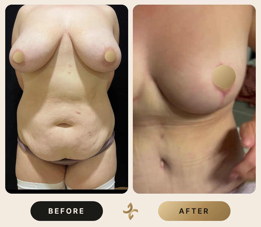 Vücut Şekillendirme ve Mommy Makeover – önce ve sonra, hasta izniyle