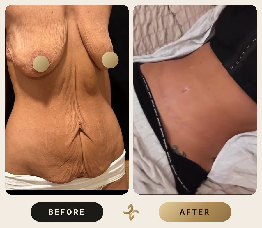 Vücut Şekillendirme ve Mommy Makeover – önce ve sonra, hasta izniyle