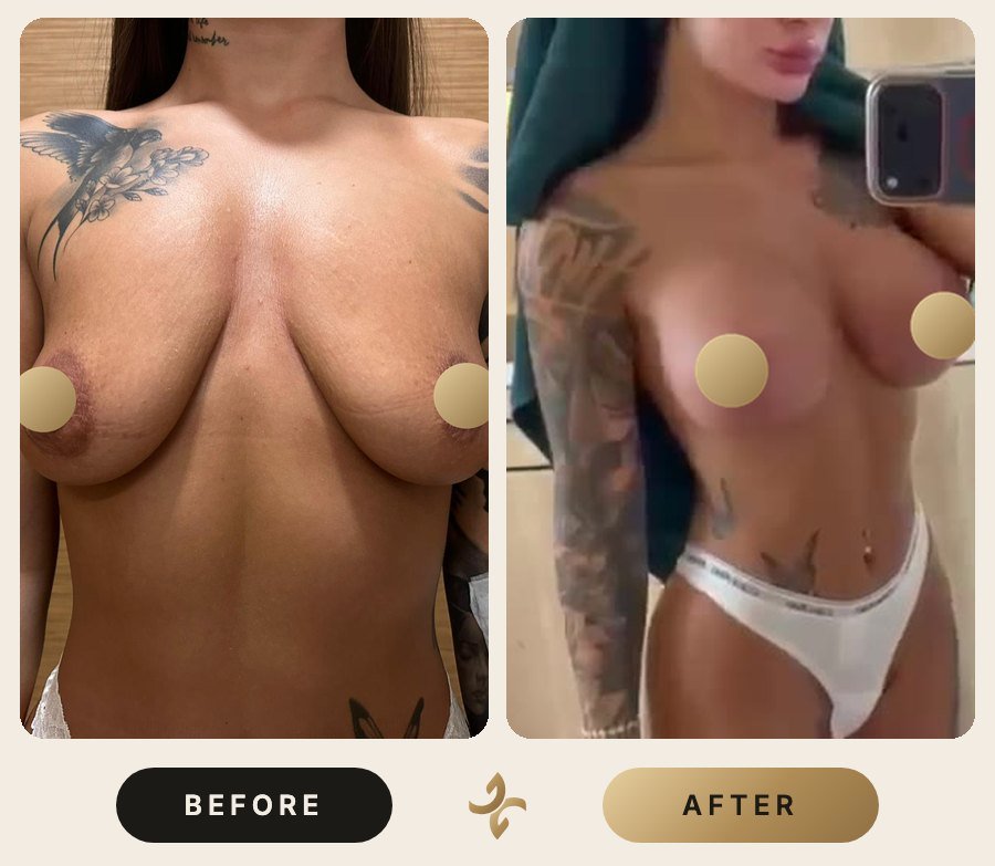 Vücut Şekillendirme ve Mommy Makeover – önce ve sonra, hasta izniyle