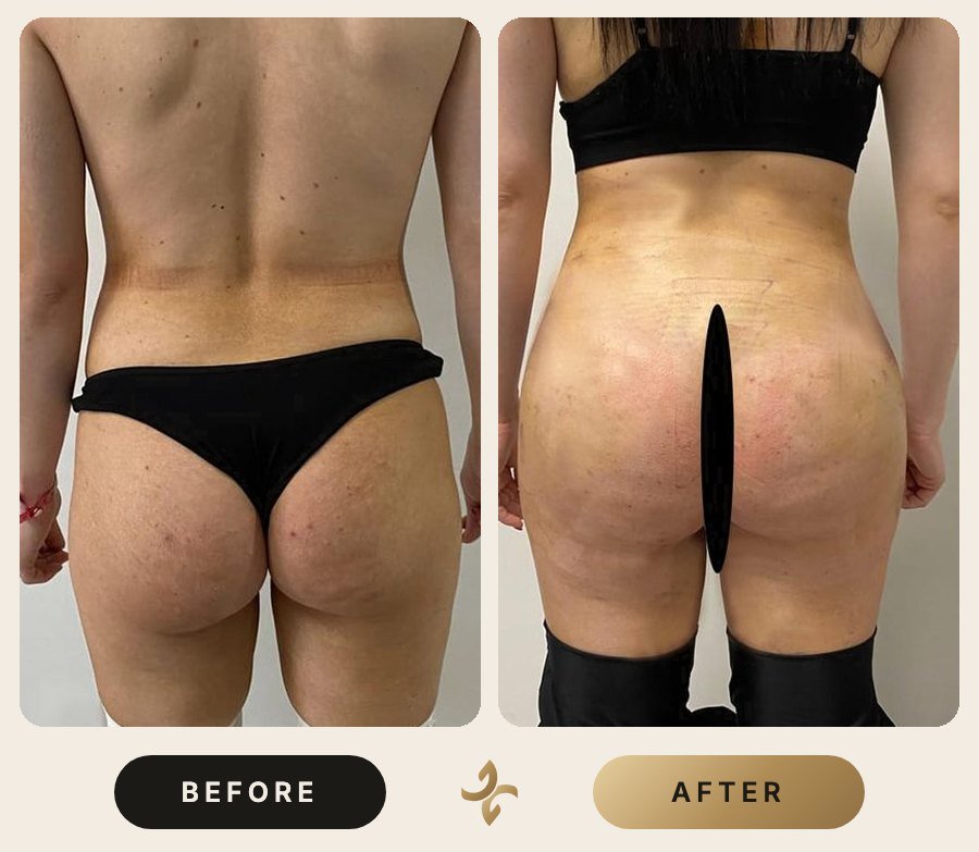 Karın Germe (Abdominoplasti) – önce ve sonra, hasta izniyle