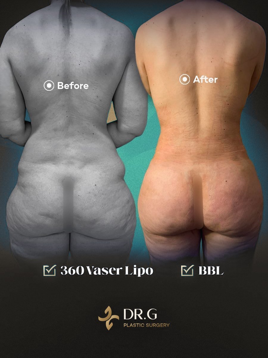 Liposuction & Vücut Şekillendirme – önce ve sonra, hasta izniyle