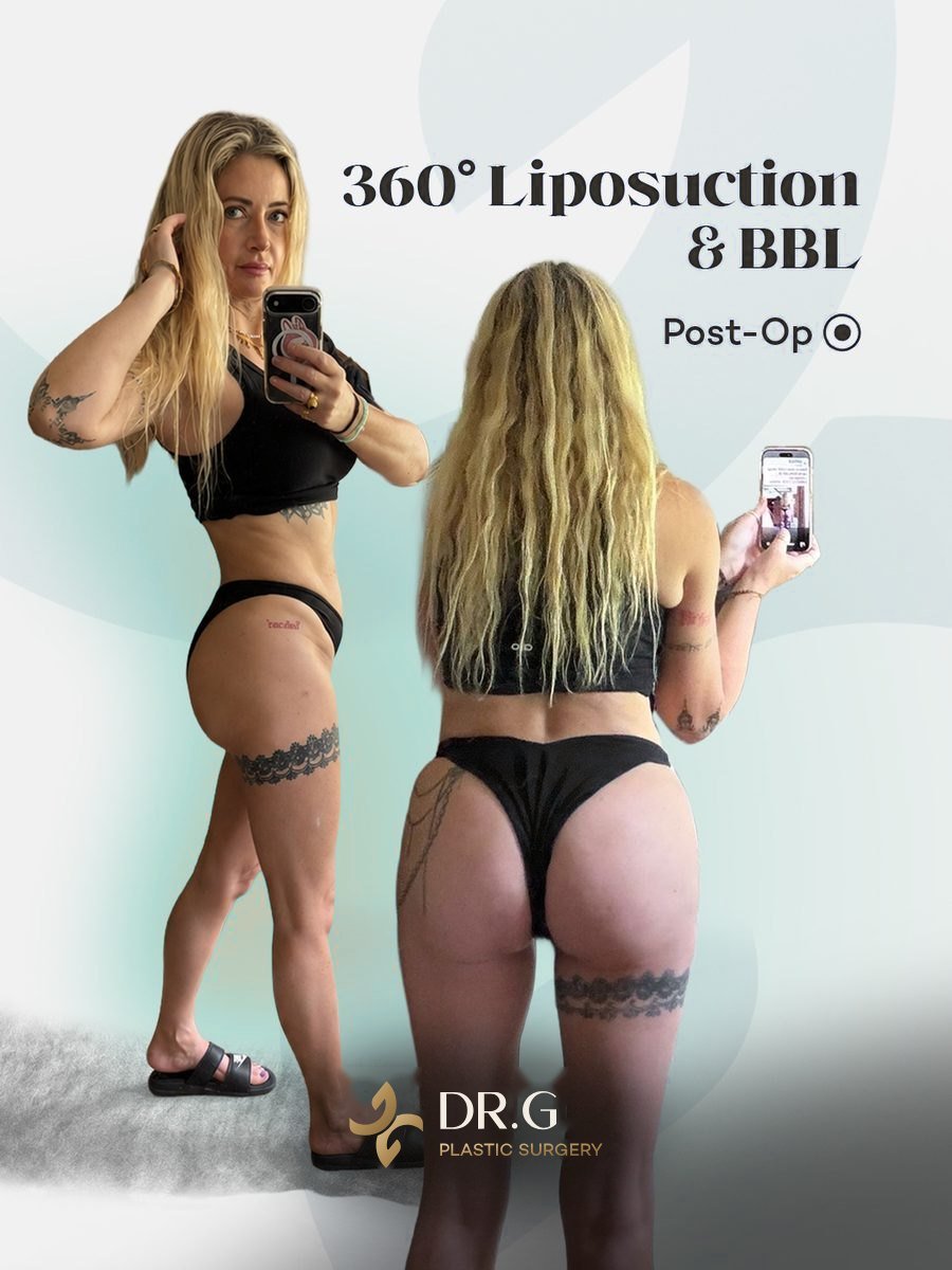 Liposuction & Vücut Şekillendirme – önce ve sonra, hasta izniyle