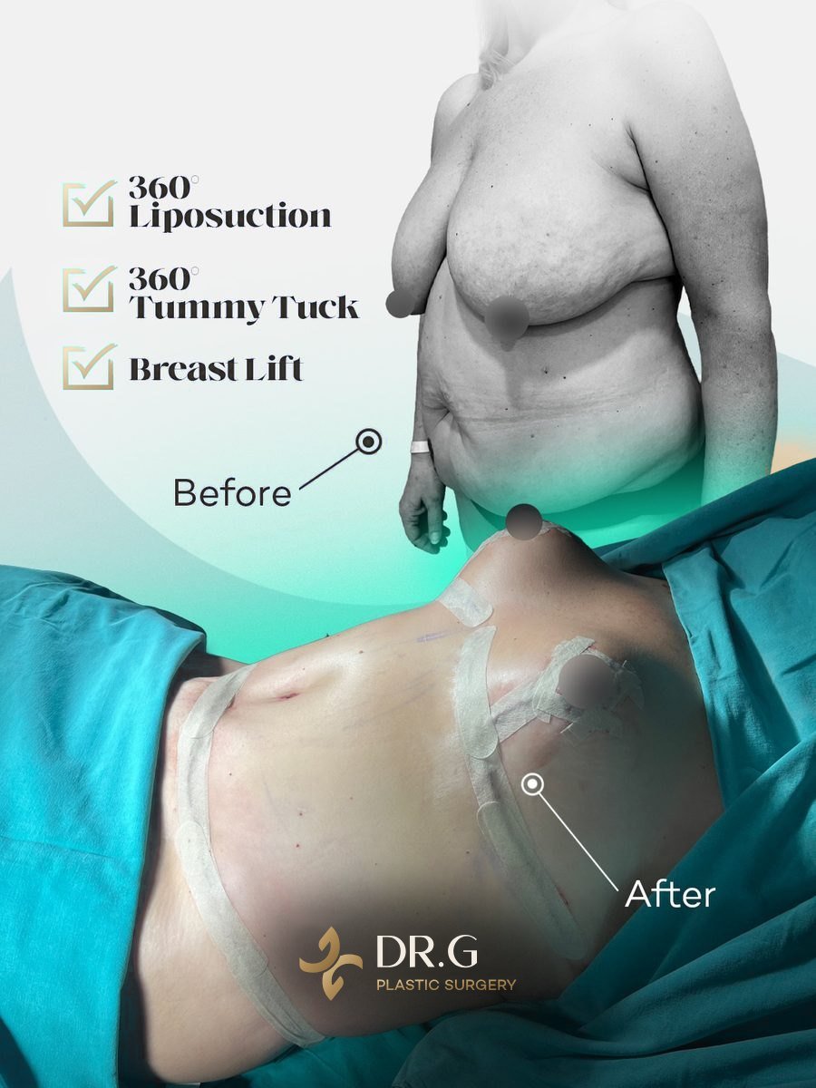 Karın Germe (Abdominoplasti) – önce ve sonra, hasta izniyle